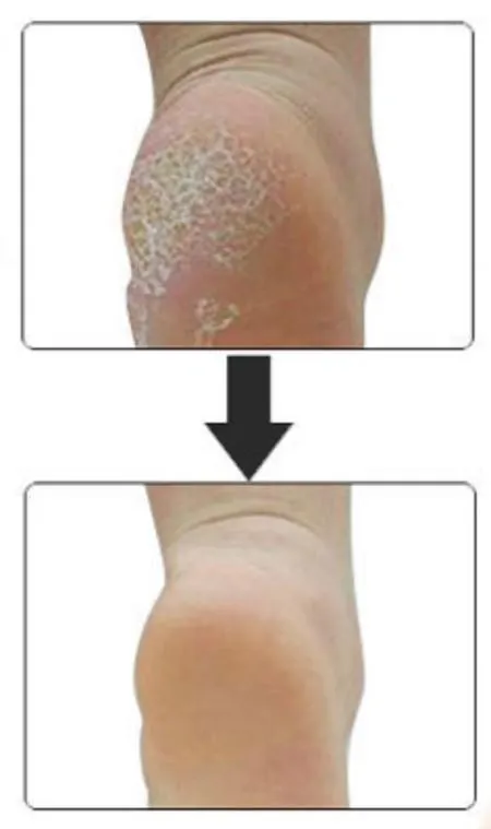 Heel Spur Relief - Plantar Fasciitis Gel Cup Massage Pads